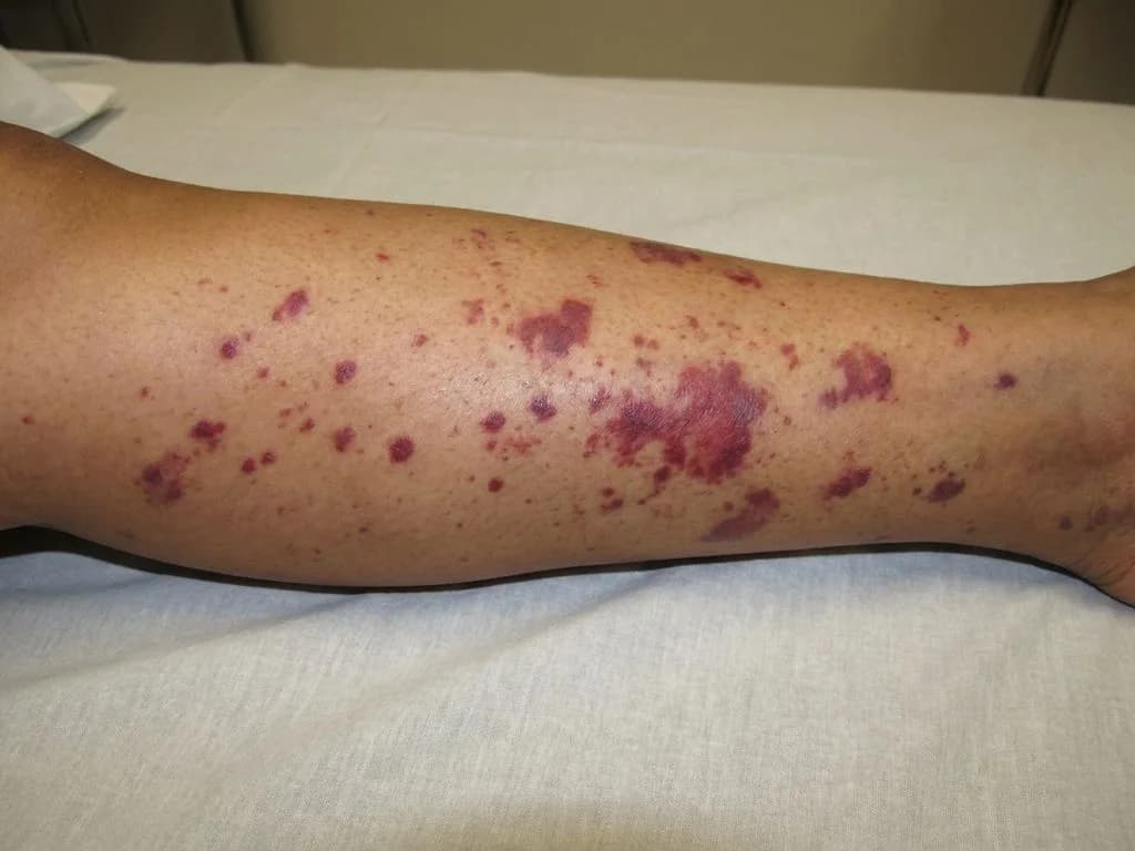Clinical image for NEET PG 2020 Q243