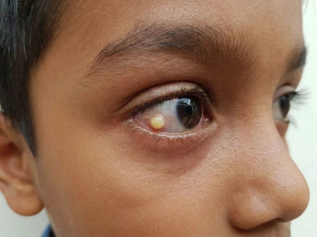 Clinical image for NEET PG 2023 Q36