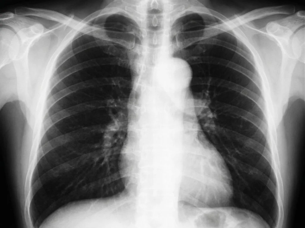 Clinical image for NEET PG 2023 Q58