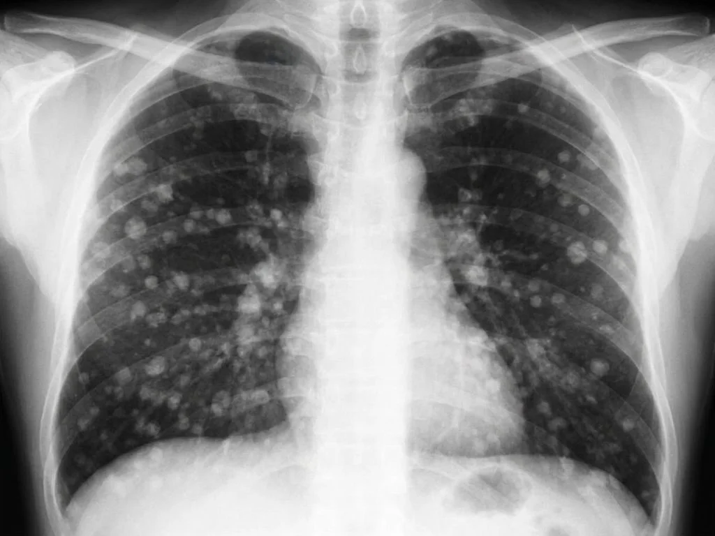 Clinical image for NEET PG 2023 Q107