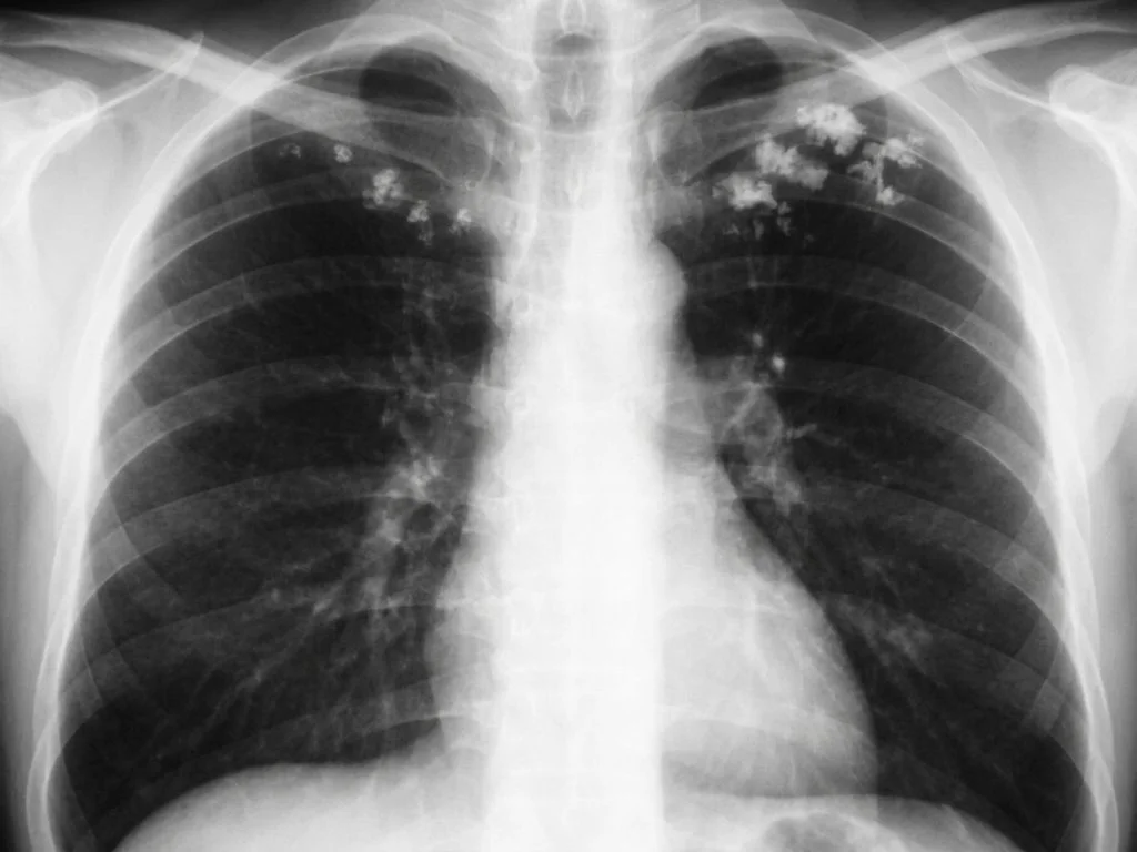 Clinical image for NEET PG 2025 Q148