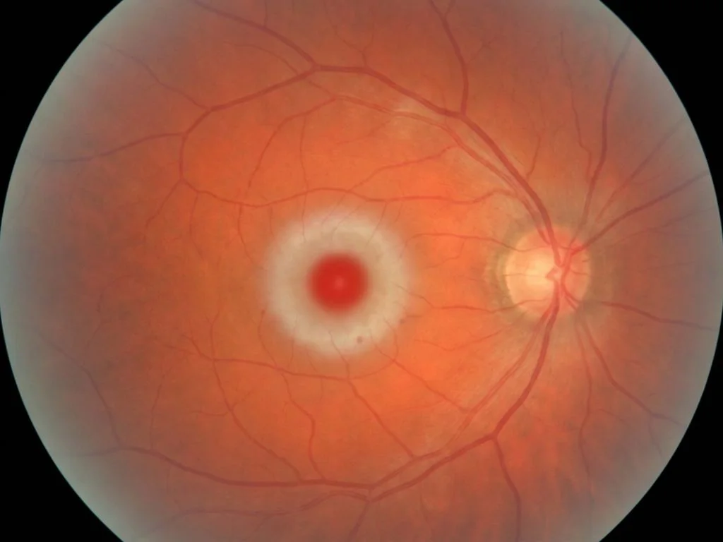 Clinical image for NEET PG 2025 Q152