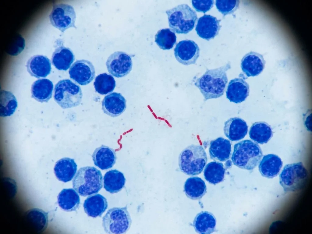 Clinical image for NEET PG 2022 Q11