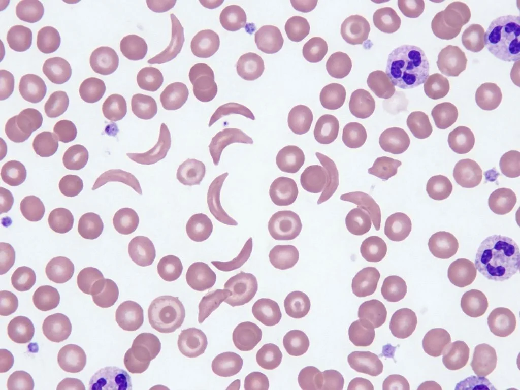 Clinical image for NEET PG 2022 Q59