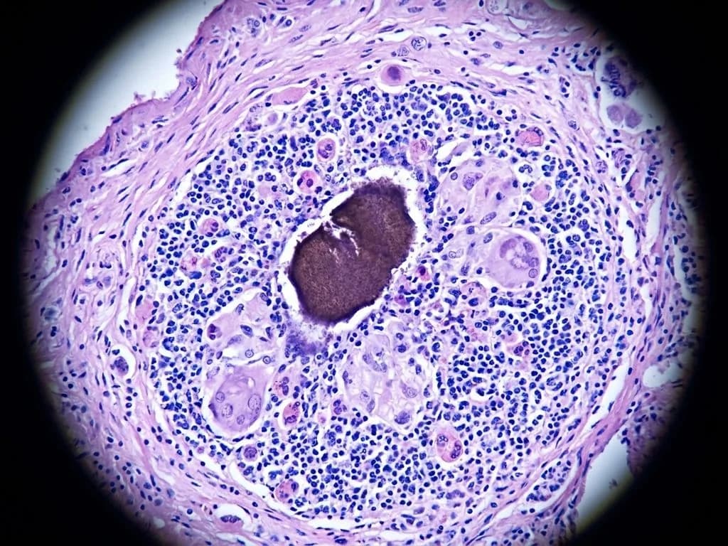 Clinical image for NEET PG 2022 Q75