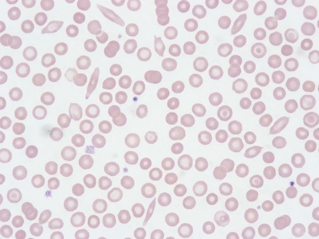 Clinical image for NEET PG 2022 Q99