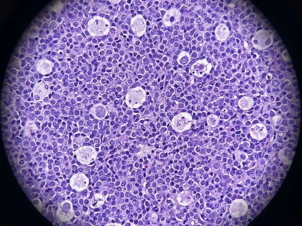 Clinical image for NEET PG 2023 Q185