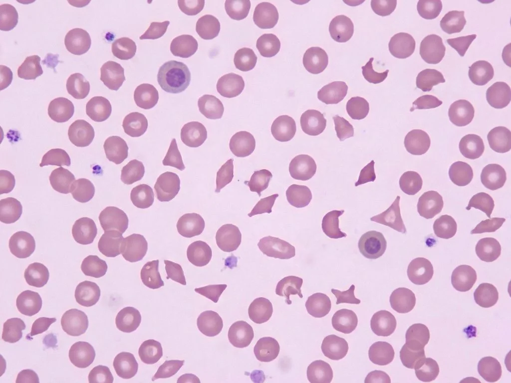 Clinical image for NEET PG 2022 Q88