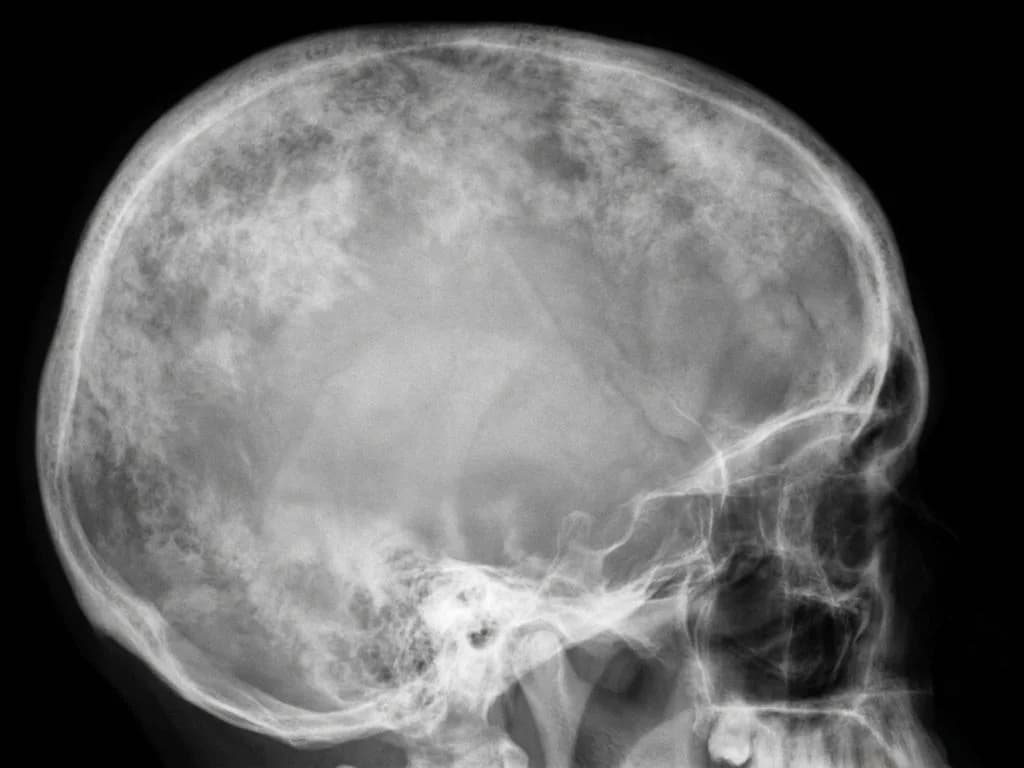 Clinical image for NEET PG 2018 Q238